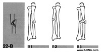 wedge fracture of the ulna